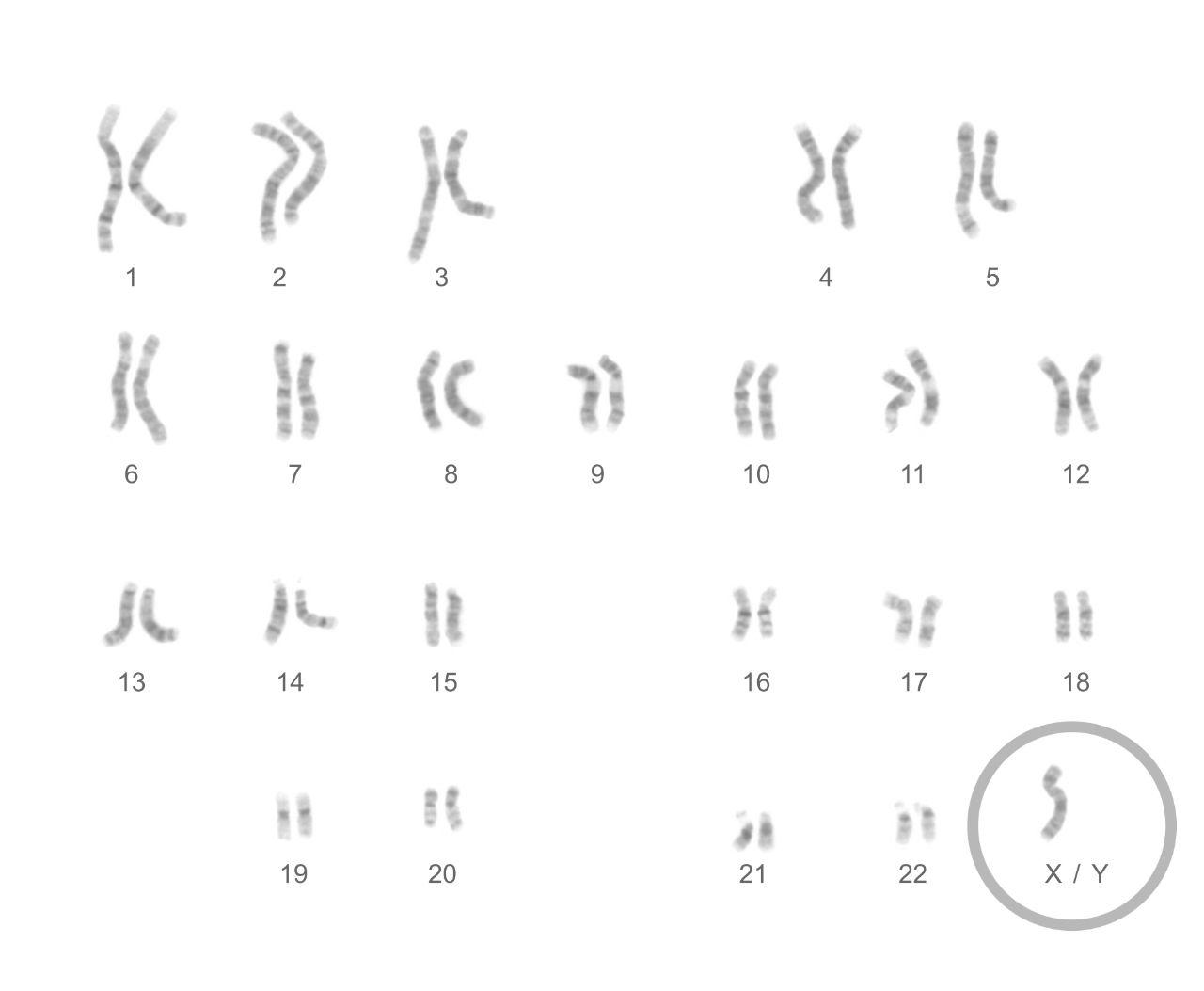 Turner syndrome