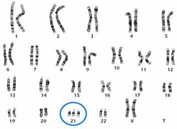 trisomy 21